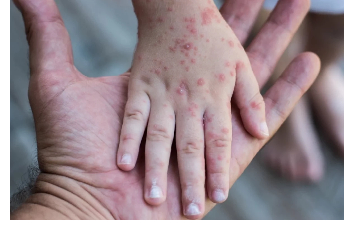virus-koksaki-atakuet-detey-v-rossii-simptomy-zabolevaniya-zafiksirovany-i-v-azerbaydzhane