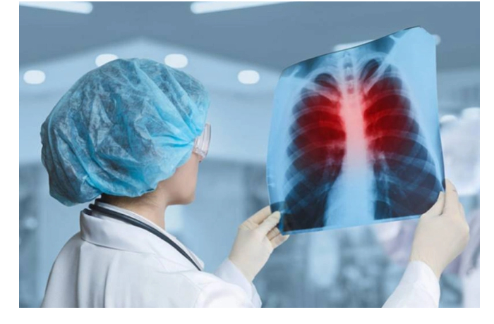 v-azerbaydzhane-snizilas-zabolevaemost-tuberkulezom-v-2025-godu