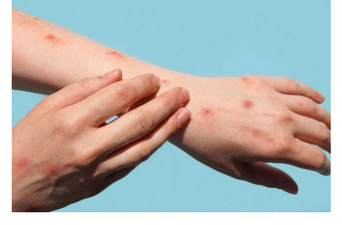 v-2025-godu-v-azerbaydzhane-nablyudalsya-rost-zabolevaemosti-vetryanoy-ospoy