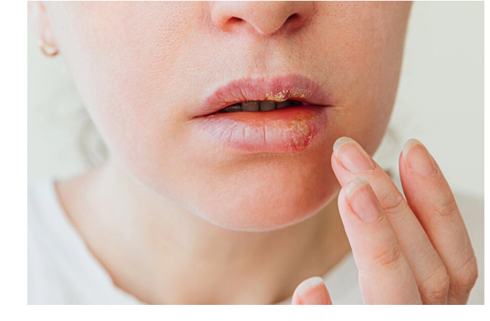 uchenye-nashli-obyasnenie-zaraznosti-virusa-gerpesa