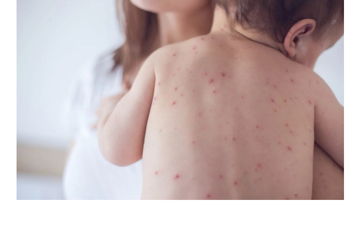 v-azerbaydzhane-zafiksirovali-10-sluchaev-kori-v-2025g