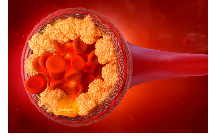 nazvan-prostoy-sposob-snizit-uroven-plokhogo-kholesterina-v-krovi