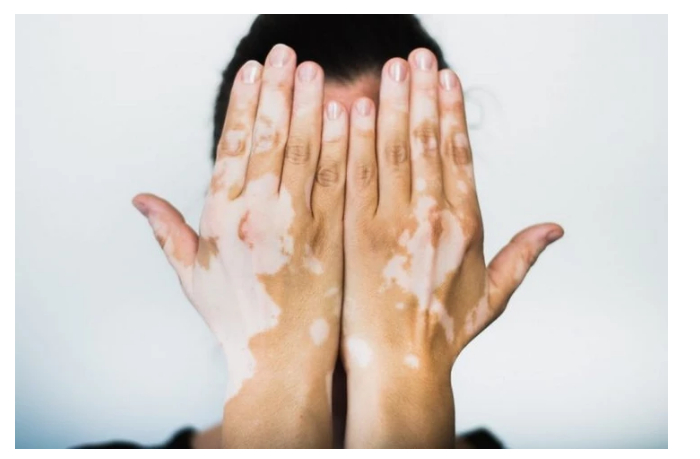 oae-stali-pervoy-stranoy-v-mire-odobrivshey-tabletki-ot-vitiligo