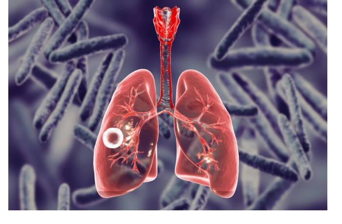deputat-predlozhil-lechit-tuberkulez-za-schet-obyazatelnogo-medstrakhovaniya